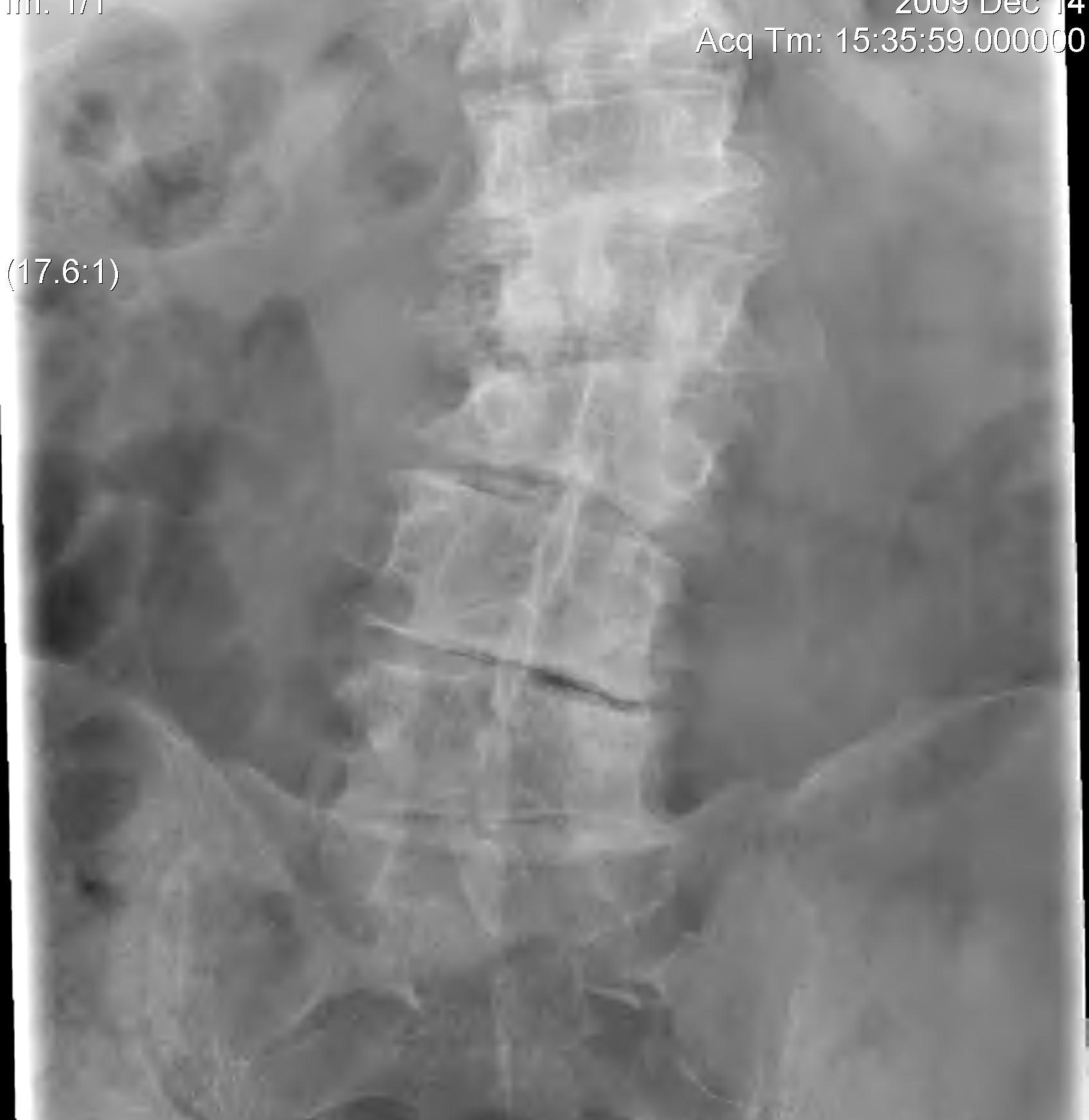 Degenerative Scoliosis AP